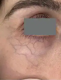 Before Nordlys vein treatment, Subject 4