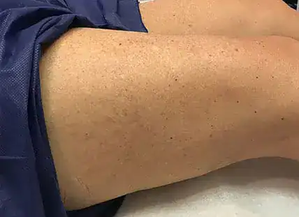 After Nordlys vein treatment, Subject 1