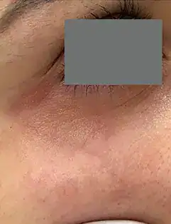 After Nordlys vein treatment, Subject 2