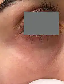 After Nordlys vein treatment, Subject 3