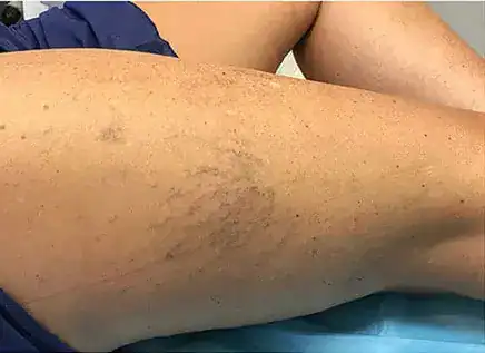 Before Nordlys vein treatment, Subject 1