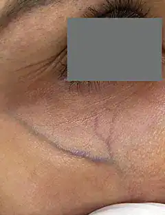 Before Nordlys vein treatment, Subject 2