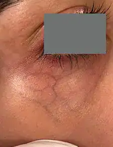 Before Nordlys vein treatment, Subject 3