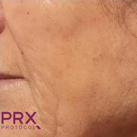 After PRX Derm Perfection treatment, Subject 1