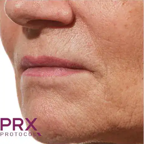 After PRX Derm Perfection treatment, Subject 2