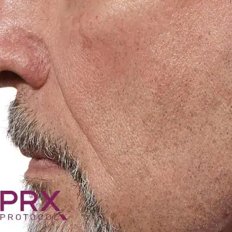 After PRX Derm Perfection treatment, Subject 3