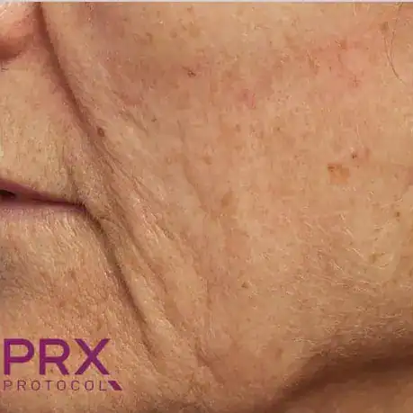 Before PRX Derm Perfection treatment, Subject 1