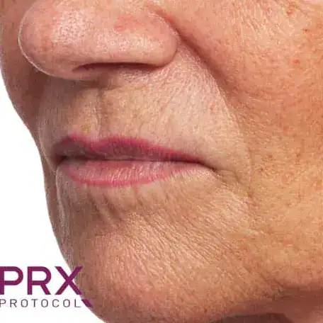 Before PRX Derm Perfection treatment, Subject 2