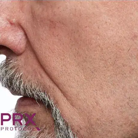 Before PRX Derm Perfection treatment, Subject 3