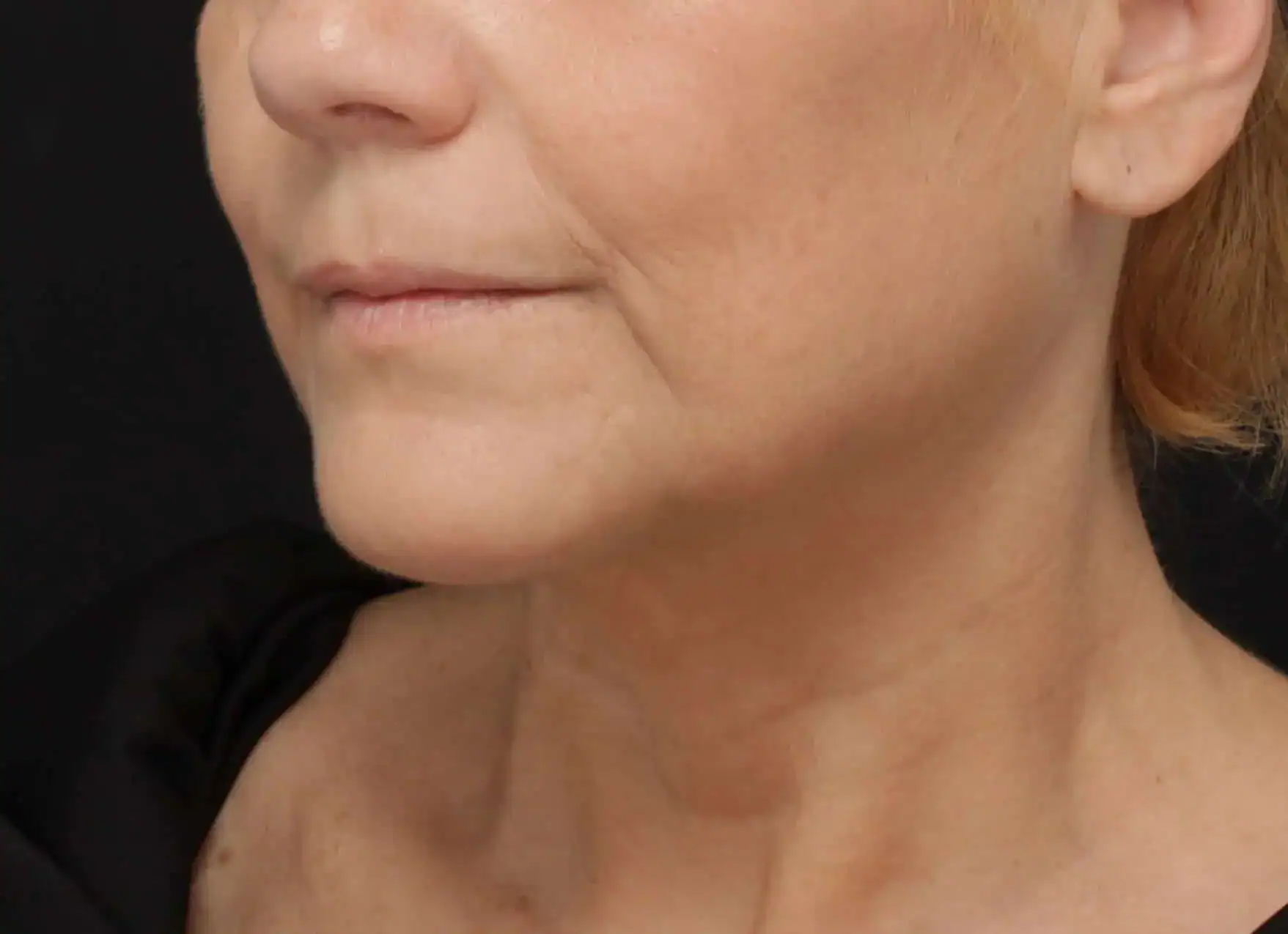 After Profound, The Evolastin Procedure, Subject 1, photo 2