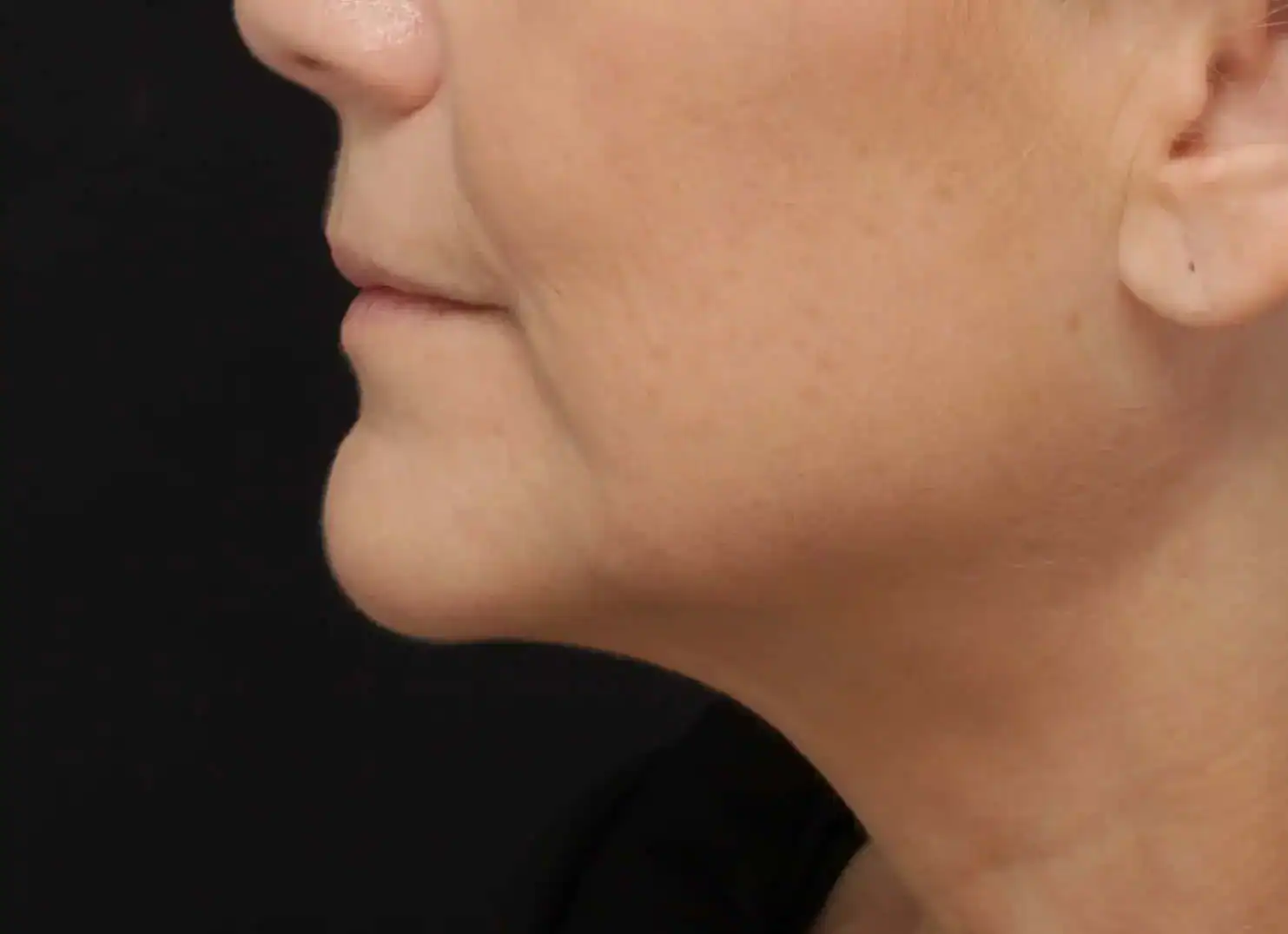 After Profound, The Evolastin Procedure, Subject 1, photo 1