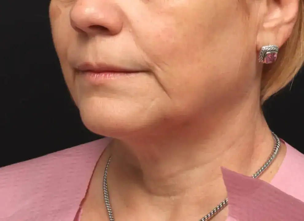 Before Profound, The Evolastin Procedure, Subject 1, photo 2