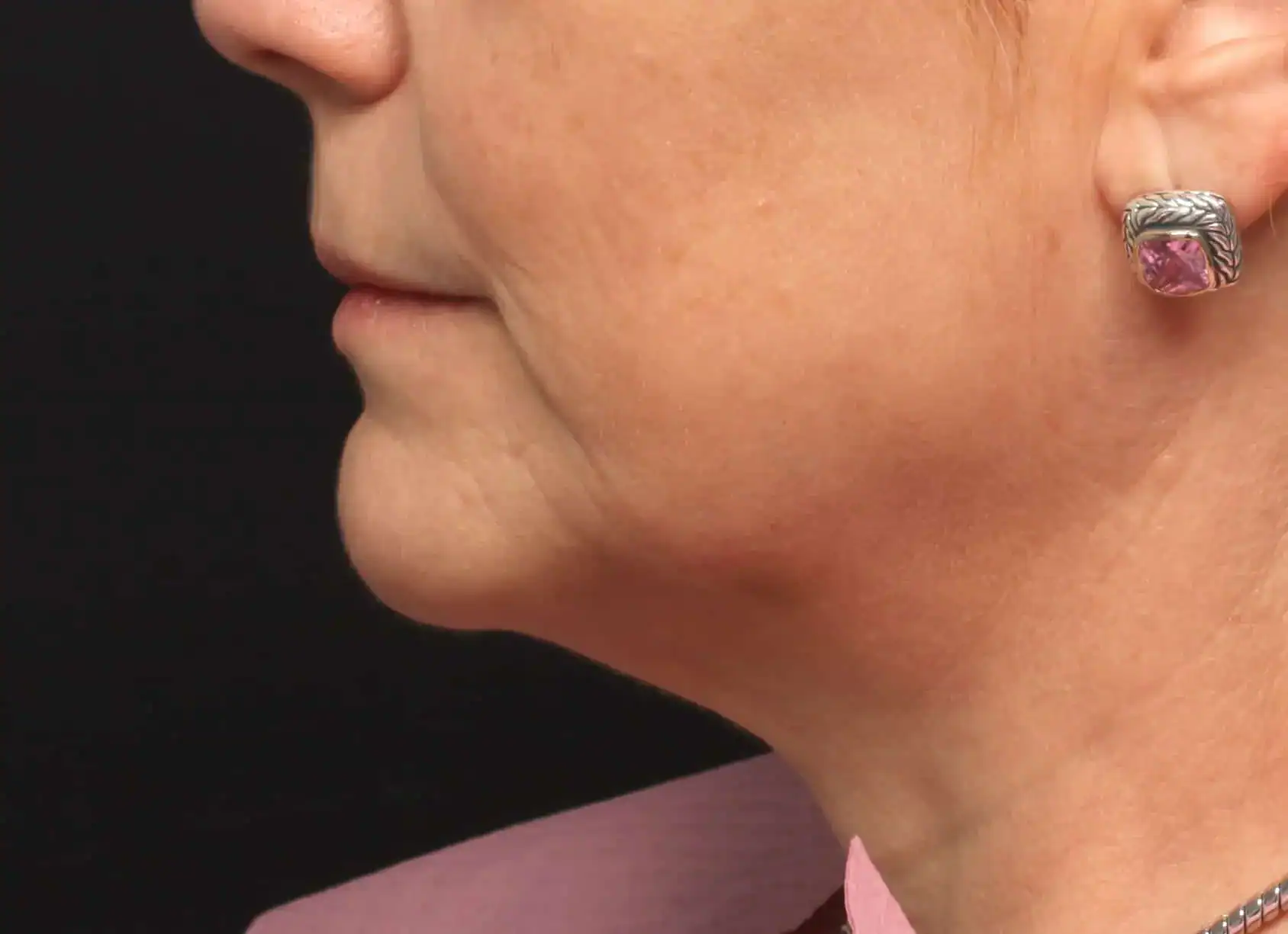 Before Profound, The Evolastin Procedure, Subject 1, photo 1