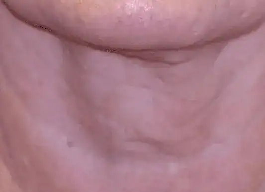 After Sofwave treatment to neck, Subject 2