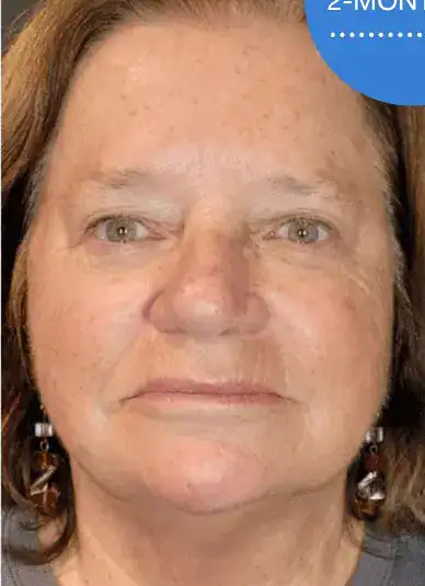 After Sofwave treatment to full face, Subject 3