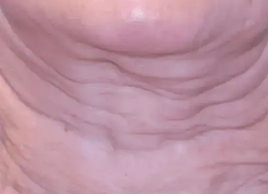 Before Sofwave treatment to neck, Subject 2