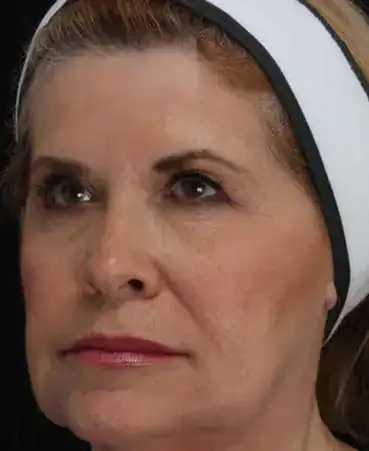 After Ultherapy treatment, Subject 1