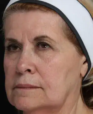 Before Ultherapy treatment, Subject 1