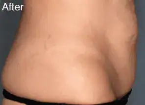 After Velashape III treatment, Subject 2