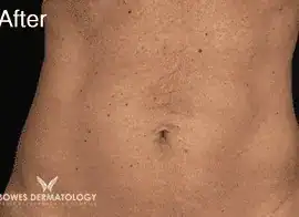 After Velashape III treatment, Subject 3