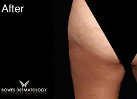 After Velashape III treatment, Subject 4