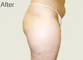 After Velashape III treatment, Subject 7