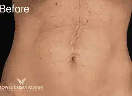 Before Velashape III treatment, Subject 3