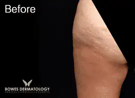 Before Velashape III treatment, Subject 4