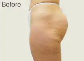 Before Velashape III treatment, Subject 6