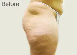 Before Velashape III treatment, Subject 7