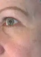 After Vivace treatment, Subject 1