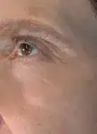 After Vivace treatment, Subject 2