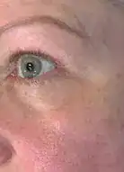 Before Vivace treatment, Subject 1