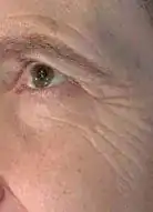 Before Vivace treatment, Subject 2