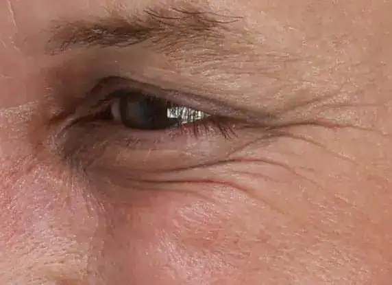 After Xeomin and Belotero treatment, Subject 1, photo 5 (left)