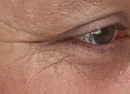 After Xeomin and Belotero treatment, Subject 1, photo 4 (right)