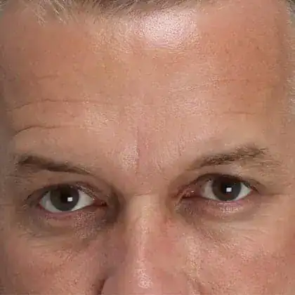 After Xeomin and Belotero treatment, Subject 1, photo 3 (forehead)