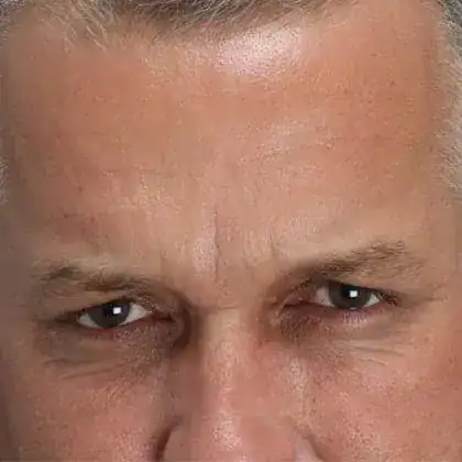 After Xeomin and Belotero treatment, Subject 1, photo 2 (squint)