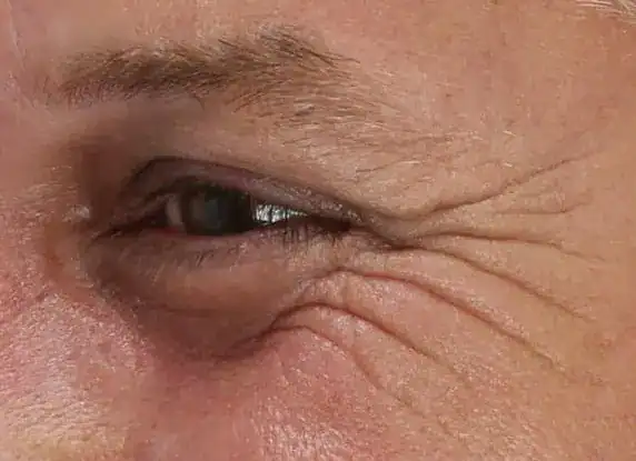 Before Xeomin and Belotero treatment, Subject 1, photo 5 (left)