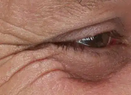 Before Xeomin and Belotero treatment, Subject 1, photo 4 (right)