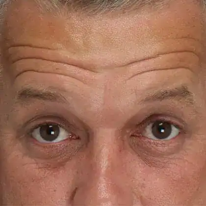 Before Xeomin and Belotero treatment, Subject 1, photo 3 (forehead)