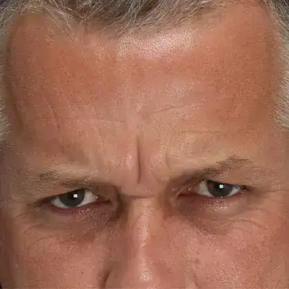 Before Xeomin and Belotero treatment, Subject 1, photo 2 (squint)