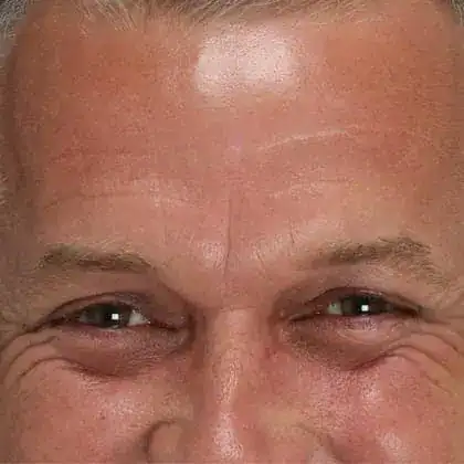 Before Xeomin and Belotero treatment, Subject 1, photo 1 (smile)