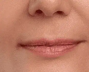 woman's lower face shown after treatment with Belotero Balance (HP)