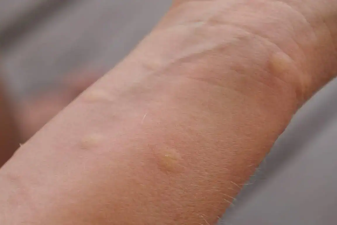 bug bites on a persons forearm
