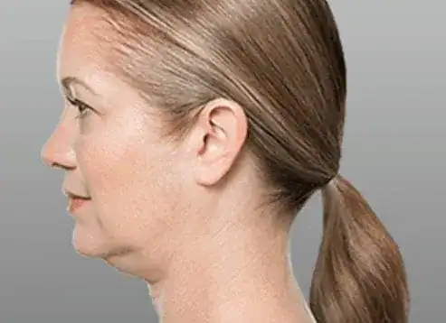 Before Kybella treatment, Subject 1