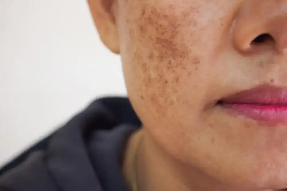 melasma patch on woman's cheek, with blog about how to treat melasma