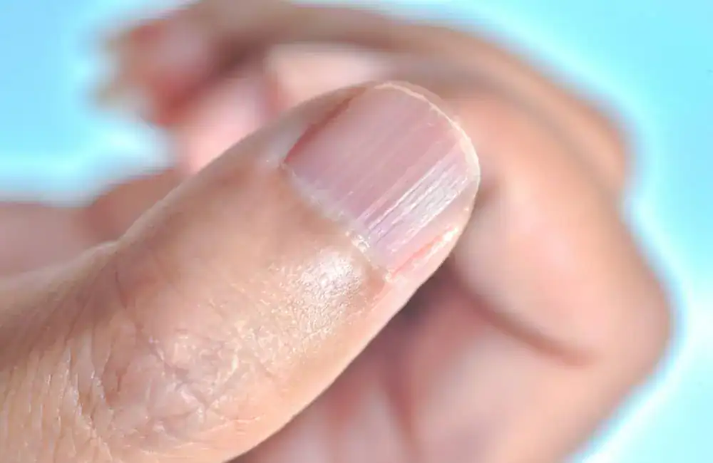 Vertical nail ridges on a man’s thumbnail