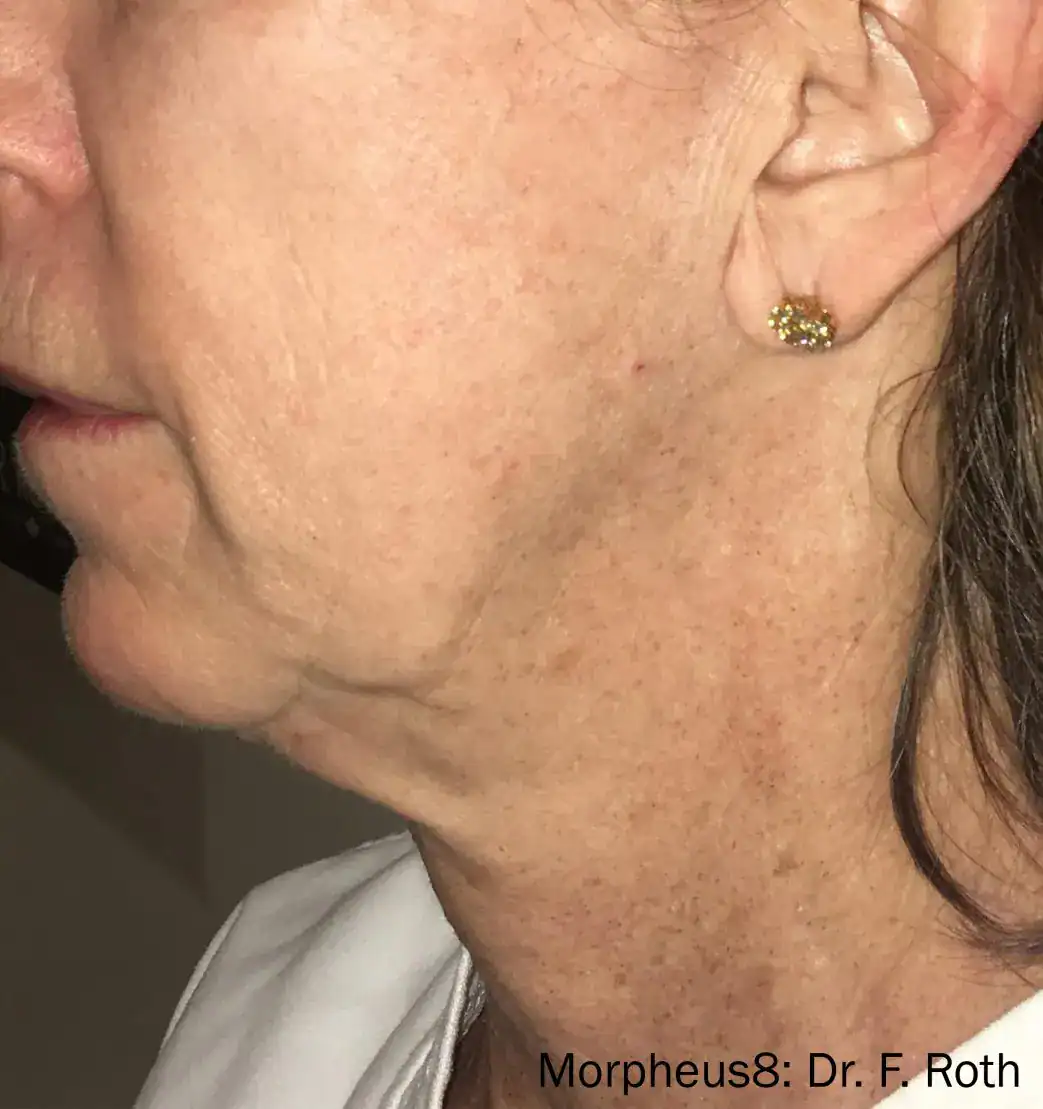 Subject 2, seen after Morpheus8 treatment by Dr. F. Roth.