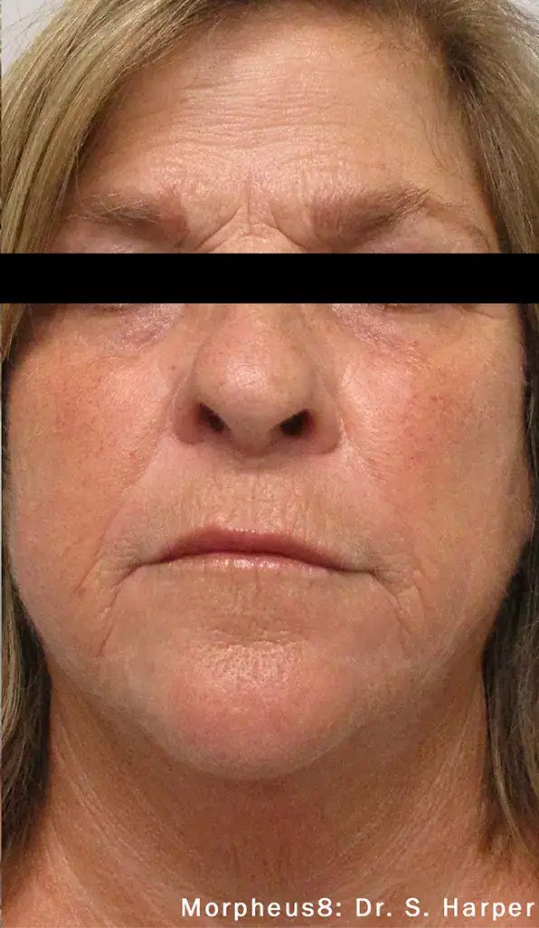 Subject 6, seen after Morpheus8 treatment by Dr. S. Harper